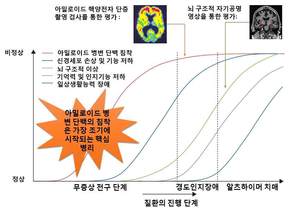 알츠하이머 치매 초기 병태생리인 아밀로이드베타 침착