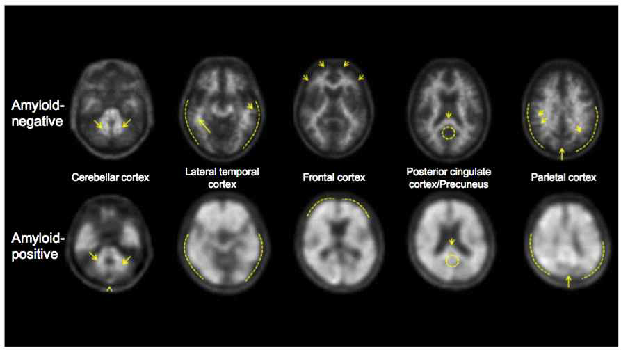 출처 Osama Sabri et al. Beta-amyloid imaging with florbetaben. Clin Transl Imaging (2015) 3:13-26