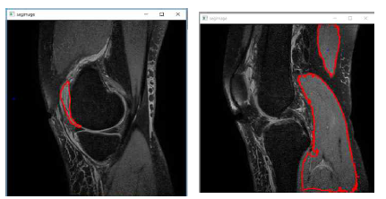 3차원 무릎연골 영상에 대한 반자동 영역 지정 알고리즘 결과 예시