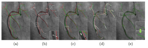 2차원 심혈관 조영 동영상의 혈관 자동 영역화의 단계별 결과 예. (a) 혈관의 전역적 평행 이동 추정, (b) 혈관 특징점(분기점, 교차점, 끝점)의 정합, (c) 일반 혈관점의 대응점 후보 확보, (d) MRF 최적화를 통한 최적 혈관 대응점 도출, (e) 조영제 확산 영역에 대한 혈관 확장 후처리