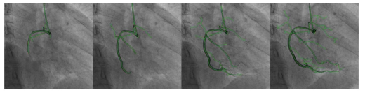 2차원 심혈관 조영 동영상 시퀸스에 대한 혈관 자동 영역화 알고리즘 결과 예시