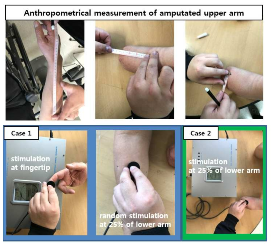 상지절단부 계측(위) 및 2단계 임상실험 실시 (아래)