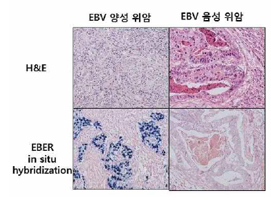 EBER in situ hybridization 방법으로 EBV 양성 위암 선별