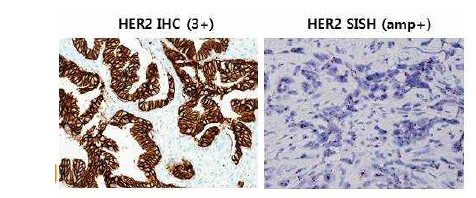 HER2 면역조직화학염색 및 은제자리교잡법