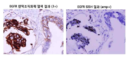 위암에서 EGFR의 면역염색 및 SISH