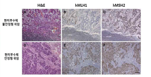 현미 부수체 불안정형 위암과 안정형 위암에서의 hMLH1, hMSH2 면역염색
