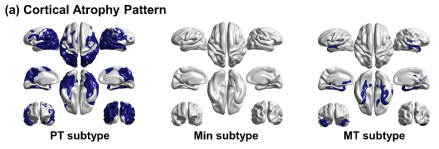 경도인지장애의 3가지 subtype