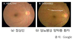 AI를 이용한 의료 이미지 판독