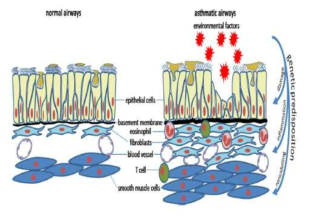 천식발생과정