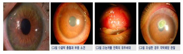 안구건조증 및 결막염 사진