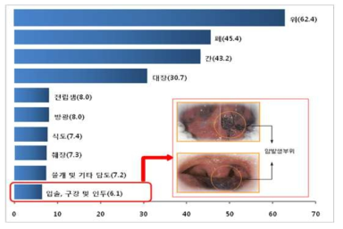 한국인 10대 암의 조사망율