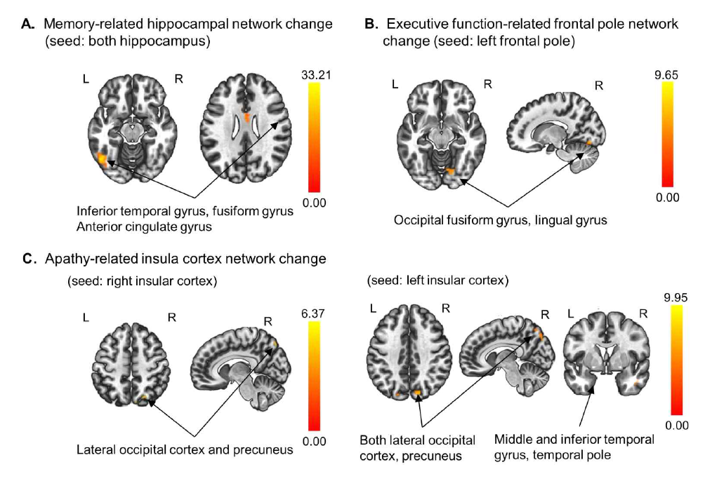 Increased brain connectivity related to improvement of memory, executive function, and apathy