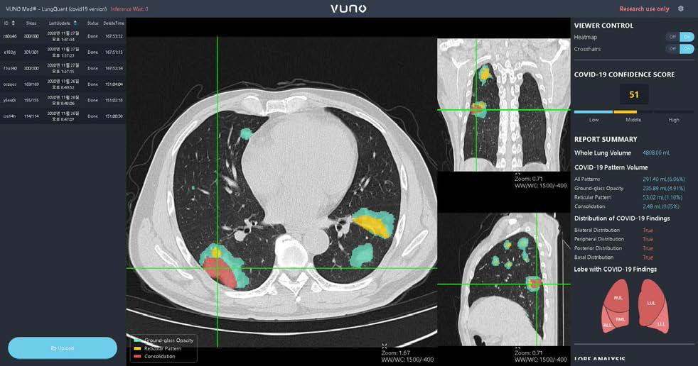 폐 CT 영상 기반 시각화 인터페이스