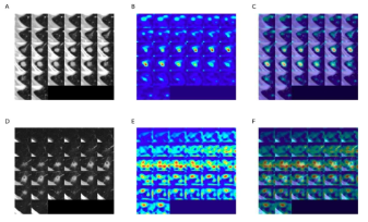 GradCAM(Gradient-weighted class activation heatmaps of nodule cubes) 기술로 예후와 연관된 영역을 시각화(Beck et al. Front Oncol 2021)