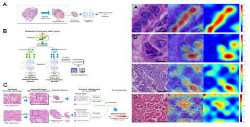 DeepRePath 모델 구조 및 예측된 재발 연관 feature 시각화 예시(Shim et al. Cancers 2021)