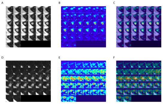 GradCAM(Gradient-weighted class activation heatmaps of nodule cubes) 기술로 예후와 연관된 영역을 시각화(Beck et al. Front Oncol 2021)