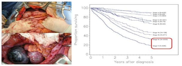 진행성 난소암의 수술 소견 및 5년 생존율