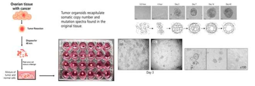 난소암 환자 유래 오가노이드 모델