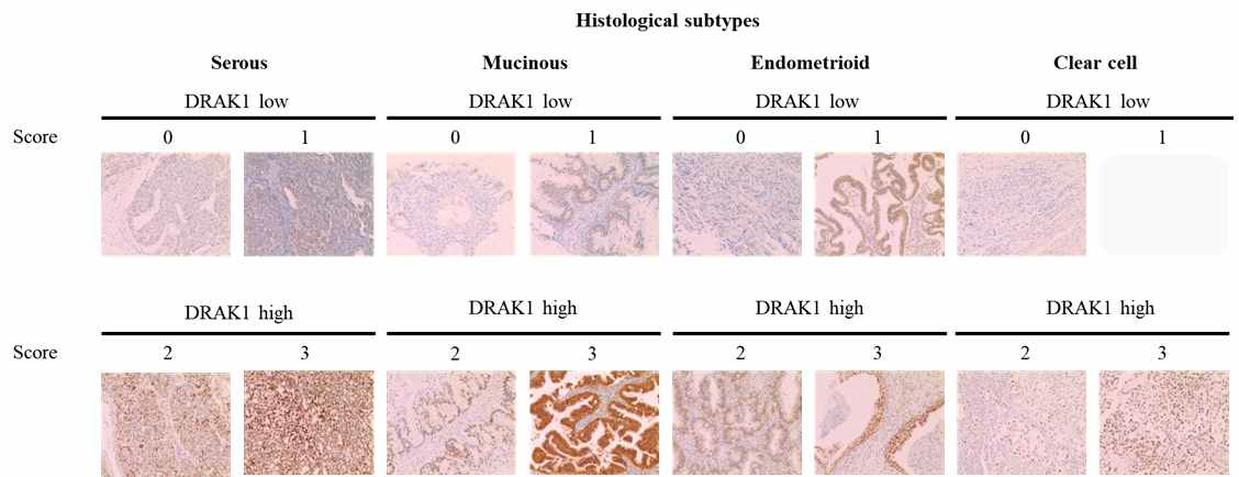 난소암 환자 TMA 조직에서 DRAK1 단백질 발현 분석