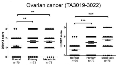 정상 조직, 난소암 원발 조직, 난소암 전이조직에서 DRAK1/2 발현 차이