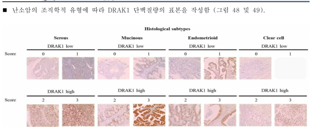 난소암 환자 TMA 조직에서 DRAK1 단백질 발현 분석