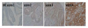 EEF1A1 protein expression in tissues of colon cancer