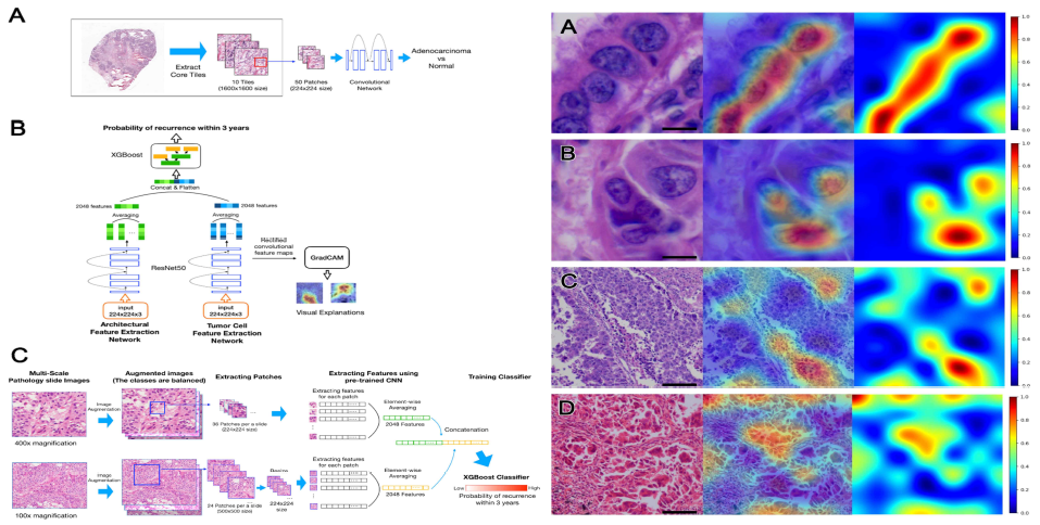 DeepRePath 모델 구조 및 예측된 재발 연관 feature 시각화 예시(Shim et al. Cancers 2021)