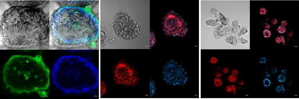 종양조직 유래 오가노이드 Confocal microscopy (Blue: DAPI, Green: CK7, 좌, Red: F-actin), 중: Clear cell RCC, 우: Papillary RCC