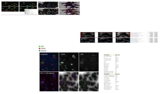 구체적인 병리 영상 분석 예시. Nuclear chromatin colocalization analysis (좌상), Haralick texture analysis (우상), Measurement of tumor microenvironment features (하)