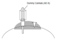 Guide cannula 보존을 위한 dummy cannula 설치 예시