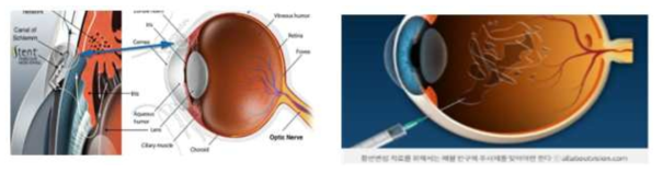 스마트 콘택트렌즈