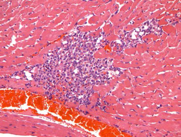 25VHM067; Infiltrate, mononuclear cell, myocardium