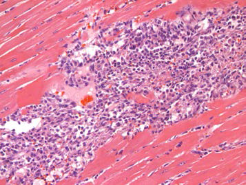 25VHM067; Infiltrate, mononuclear cell with fibrosis, myocardium