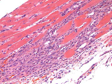 25VHM067; Fibrosis, myocardium