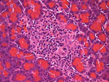 25CM002; Infiltrate, mononuclear cell