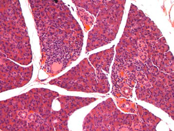 25CM003; Infiltrate, mononuclear cell