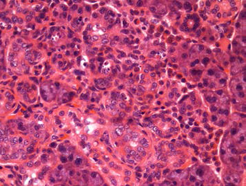 25VHF129; Infiltrate, mononuclear cell and eosinophil