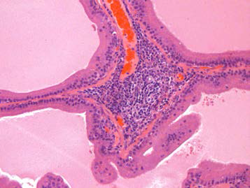 25VHM072; Infiltrate, mononuclear cell, perivascular