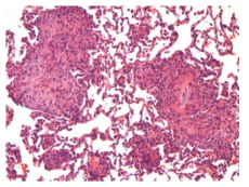 25CM007; Inflammation, granulomatous