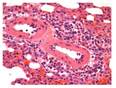 25VHM057; Infiltrate, eosinophil, perivascular