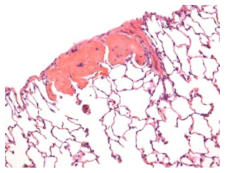 25CF075; Metaplasia, osseous