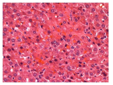 25CM005; Inclusion, intracytoplasmic, eosinophilic