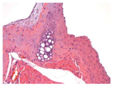 25VHM068; Cartilaginous foci