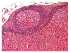 25CF082; Ectopic tissue, adrenocortical