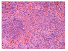 25VHF142; Necrosis with inflammation