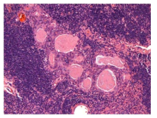 25CF135; Epithelial cells, increased, medulla