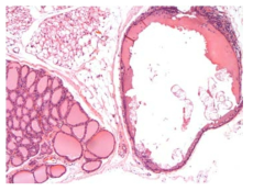 25CF079; Cystic follicle with inflammatory cell infiltrate