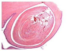 25CF073; Cyst, squamous