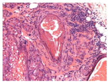 25VHM068; Inflammation, chronic