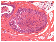 25VHM054; Sperm granuloma